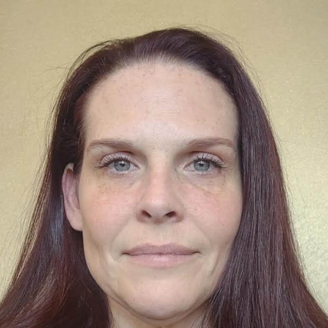Forehead Reduction Surgery BEF